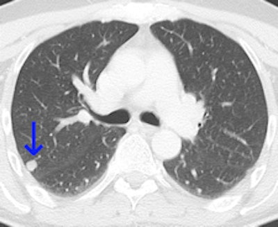 CT image of 62-year-old melanoma patient