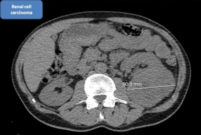 Large renal tumor on screening lung CT