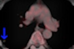 2012 06 26 08 10 55 653 2012 06 26 Pet Ct Melanoma Thumb2