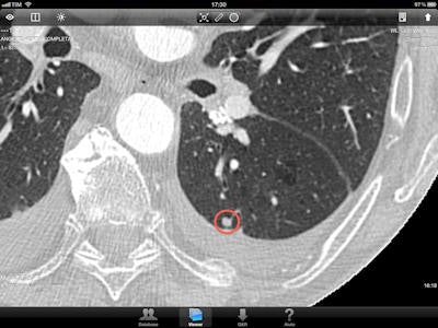 Screen capture of a pulmonary nodule as displayed on the iPad 2. All images courtesy of Dr. Lorenzo Faggioni.