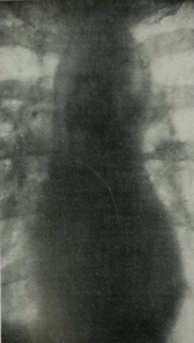 1903 radiograph of the heart