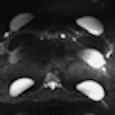 2012 06 29 15 02 24 565 2012 07 02 Implant Thumb
