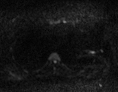 Combination chemical suppression technique of STIR and SSGR