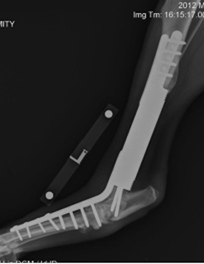 These images show treatments for osteosarcoma in a dog. Left: Radius and ulna custom modular endoprosthesis with hydroxyapatite collars and carpal arthrodesis. Right: Distal tibia custom modular endoprosthesis with hydroxyapatite collar and tarsal arthrodesis. Images courtesy of Dr. Noel Fitzpatrick.