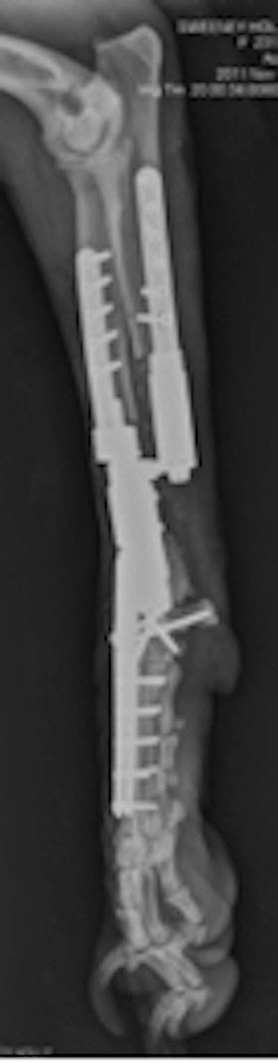 Radius and ulna custom modular endoprosthesis with hydroxyapatite collars and carpal arthrodesis