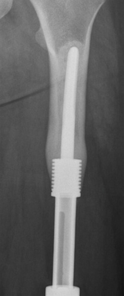 Endoprosthesis collars in a human femur show the same kind of in-growth that are seen in the collars in animals. Image courtesy of Dr. Gordon Blunn, University College London.