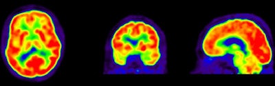 FDG-PET images show a normal brain with normal functions (red)