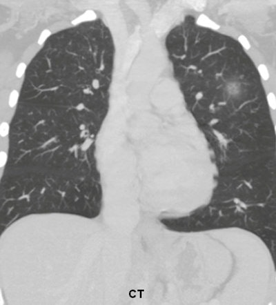 2012 07 17 11 43 00 275 2012 07 18 Pneumonia C