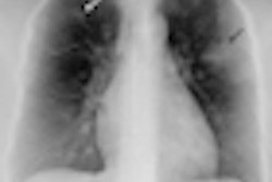 2012 07 17 11 43 00 718 2012 07 18 Pneumonia Thumb