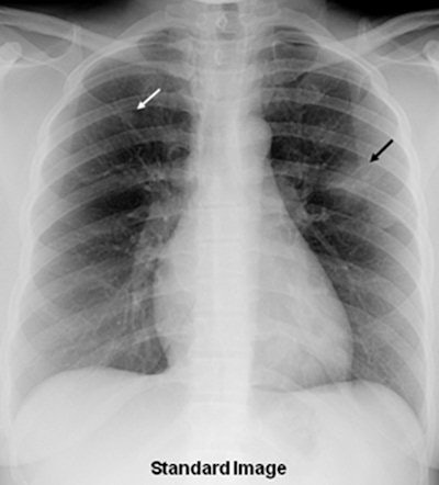 Portable chest radiograph shows focal airspace opacity in left upper lobe and a faint nodule in right upper lobe (arrows)