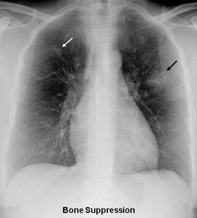 A 36-year-old woman with focal pneumonia. Top: Portable chest radiograph shows focal airspace opacity in left upper lobe and a very small nodule in right upper lobe (arrows). Above: Bone suppression image shows these airspace opacities more clearly. Below: Coronal reconstruction from CT scan performed five days later. The right opacity had resolved and the left opacity had decreased on the follow-up CT. All images courtesy of Dr. Feng Li.