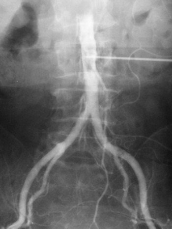 Translumbar aortograms like this one used to be the standard vascular exam. All images courtesy of Dr. Adrian Thomas.