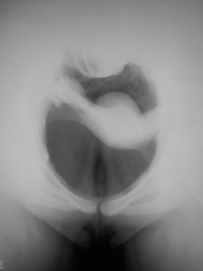 This technique, performed as late as 1967, was the predecessor to ultrasound.