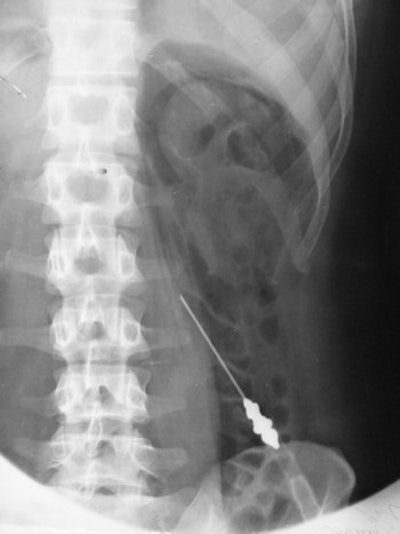 This retroperitoneal air study was performed in 1943 using a 10-cm needle.