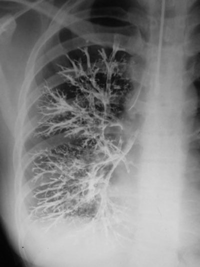In bronchography, a catheter was used with contrast injected to examine the bronchial tree.