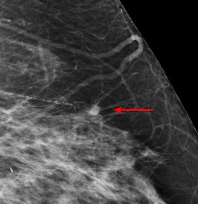 Invasive cancer detected by CAD