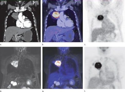 PET/CT and PET/MR of woman with lung cancer