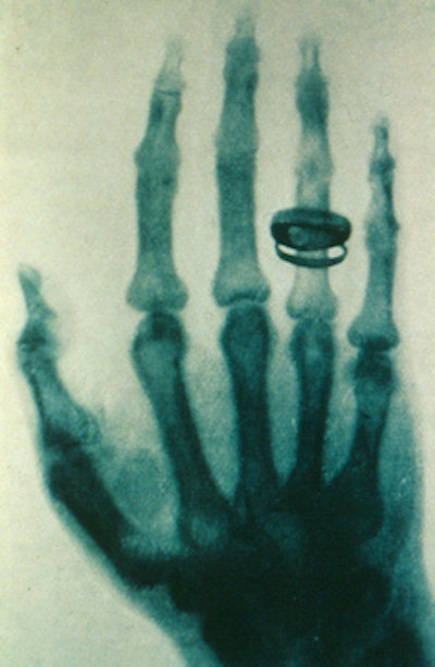 One of Röntgen's early images.