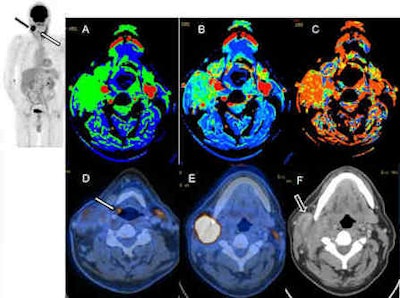 These images are of a 56-year-old man with suspected hypopharyngeal cancer and ipsilateral lymph node metastases. The maximum intensity projection (MIP) image (top left, white arrow) shows the small tumor at the aryepiglottic fold in the right side (D) with focal FDG avidity. Additionally, a large lymph node metastasis with high FDG activity was detected right cervically (black arrow on MIP image and E, F). Perfusion imaging of the large lymph node (A-C) shows elevated blood flow (A), blood volume (B), and also a decreased mean transit time (C). Images courtesy of Dr. Patrick Veit-Haibach.