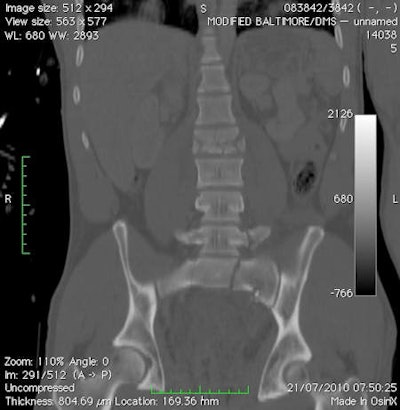 CT reformat of the sacrum and lumbar spine