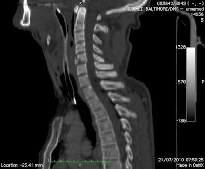 These two images are from a soldier in a vehicle hit by an improvized explosive device. Above: A lateral CT reformat of the cervical spine with an anterior inferior fracture of C5. Below: A coronal CT reformat of the sacrum and lumbar spine. The patient demonstrates a left vertical sacral fracture, left transverse fracture of L5, and burst fracture of L2. All images courtesy of Dr. Richard Graham.