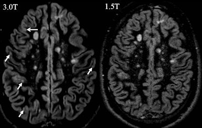 Axial double inverison recovery images at 1.5-tesla and 3-tesla in a patient with multiple sclerosis. Please note that at 3-tesla more cortcial gray matter lesion can be identified.