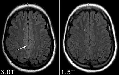Axial 1.5-tesla and 3-tesla FLAIR obtained in a patients presenting with a clinically isolated syndrome suggestive of multiple sclerosis. Please note that at 3-tesla one juxtacortical lesion could be identified that was not prospectively scored on the 1.5-tesla images.