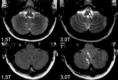 Axial FLAIR (bottom) and T2-weighted images (top) obtained at 3-tesla (right) and 1.5-tesla (left). The 3-tesla MRI shows more an inflammaory lesion in multiple sclerosis patients in the posterior fossa, which is clincially highly relevant because infratentoral lesions play an important role in the current diagnostic criteria and do have predictive value in terms of long term disability. All images courtesy of Dr. Mike Wattjes.