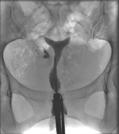 HSG of a 38-year-old patient with irregular nodular configuration of the right tube (salpingitis isthmica nodosa). The left tube is proximally occluded. Because the patient had decided that she did not want more children, there was no further workup. The HSG was performed to assess the need for anticonception.