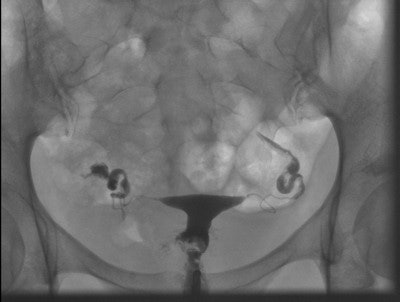 A 35-year-old patient with an irregular-shaped defect localized at the right side of the cervix, which was identified as a myoma using transvaginal sonography. No tubal pathology. No follow-up information was available for this external patient. All images courtesy of Dr. Adrian Schankath.