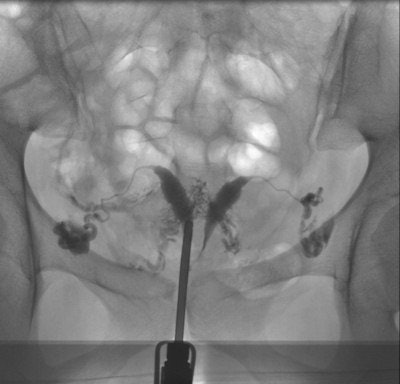 A 32-year-old patient with symmetrically separated uterine cavity (uterus septus). Also, notice venous intravasation of the contrast medium. Laparoscopy and hysteroscopy were performed, and the septum was resected. After this procedure, the patient was lost to follow-up.