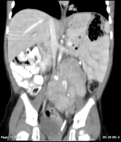 CT of abdomen and pelvis in 15-month-old girl was performed for follow-up of neuroblastoma (80 kV, 57 average effective mAs, CTDIvol = 2.6 mGy, DLP = 69 mGy cm, E = 1.6 mSv). Image displayed is coronal reconstruction, which shows partly calcified mass in left abdomen. Ureteric stent was noted in bladder.