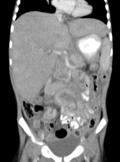 CT of abdomen and pelvis in 3-year-old girl was performed to reassess recurrence of neuroblastoma (80 kV, 70 average effective mAs, CTDIvol = 3.2 mGy, DLP = 112 mGy cm, E = 2.6 mSv). Coronal CT of abdomen shows para-aortic mass.