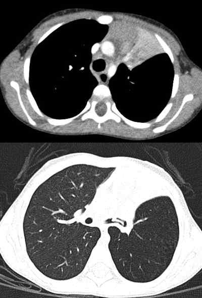 Chest CT of 3-year-old boy performed because of chronic cough and left upper lobe (LUL) collapse (80 kV, 53 average effective mAs, CTDIvol = 2.5 mGy, DLP = 58 mGy cm, E = 1.9 mSv). Images show normal vascular enhancement and LUL collapse in upper image with mediastinal window settings and foreign body in left main bronchus in the lung window images.