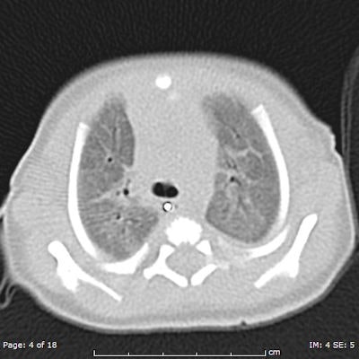 Chest CT of 8-day-old girl with respiratory distress (80 kV, 51 average effective mAs, CTDIvol = 2.3 mGy, DLP [dose length product] = 33 mGy cm, E[effective dose] = 1.1 mSv. CT was performed to exclude congenital lung abnormalities because of family history and small volume lungs. Image shows ground glass opacity and septal lines consistent with respiratory distress syndrome. In all four figures, CTDIvol and DLP are expressed in terms of the 16 cm CT dosimetry phantom; these should be divided by approximately two to be expressed in terms of the 32 cm CT dosimetry phantom. Effective dose was calculated from DLP using conversion coefficients specific to this scanner and using the International Commission on Radiological Protection Publication 103 definition of effective dose. All images courtesy of Zoe Brady, PhD.