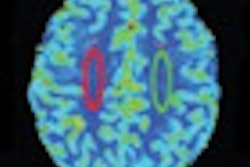 2012 08 21 15 54 47 845 Ccsvi Ms Rad Garaci Thumb