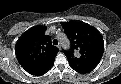 CT scan of the same lung cancer nodule in left upper lobe in mediastinal window