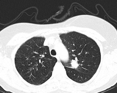 Above: CT scan of lung cancer nodule in left upper lobe in lung window. Below: CT scan of the same lung cancer nodule in left upper lobe in mediastinal window. Images courtesy of Dr. Marlies Heuvers.