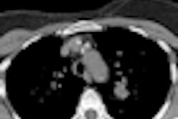 2012 08 22 14 52 36 435 2012 08 23 Ct Lung Screening2 Thumb