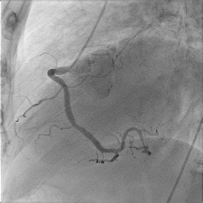 Images of the left and right coronaries taken on the AlluraClarity system, incorporating a 50% reduction in radiation dose. Images courtesy of Dr. Yves Taeymans.