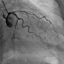 Left coronary