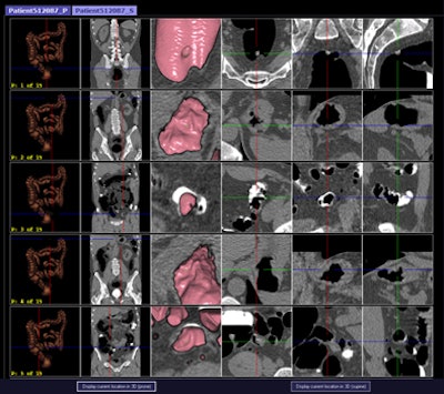 CAD first-reader gallery evaluation shown in a screening patient with a 10-mm tubular adenoma in the rectum. Above (left monitor), all 15 CAD markers in a volume are presented to the reader, line by line, as a collection of CT image galleries. They are sorted top to bottom by decreasing level of confidence, as computed by the CAD algorithm both for the prone (shown) or for the supine (not shown) position. CAD finding P:1 (first row of images) displays the polyp (crosshair) in all six gallery images. Note that the typical imaging characteristics of a polyp are already recognizable within the gallery images. The remaining CAD findings P:2-P:5 (image rows 2-5) display false-positive detections in the stomach (P:2), on the residual fluid layer (P:3), in the stomach (P:4), and in the terminal ileum. CAD findings P:6-P:15 are not shown. Below (right monitor), standard axial and optional coronal and sagittal 2D images (not shown). Optional 3D target views (not shown) of prone and supine datasets are used, first, to further evaluate potential polyp candidates or CAD findings on complex structures and, second, to perform a complete 2D review of the prone and the supine CTC datasets. The 2D axial prone and supine CT images show the polyp (crosshair) marked by CAD (marker 1) in both positions. All images courtesy of Dr. Thomas Mang.
