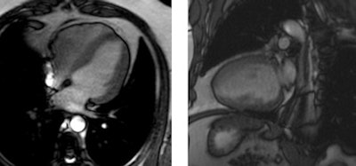 Cardiac magnetic resonance end-diastolic images in the four- and two-chamber view of a subject with cocaine addiction. Concentric left ventricular hypertrophy can be seen, with a quantified left ventricular mass index of 103g/m². Images courtesy of Dr. Alicia Maceira.