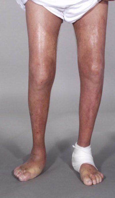 Skin lesions due to NSF. The legs demonstrate typical skin lesions due to NSF in the lower extremities. All images courtesy of Dr. Henrik Thomsen.