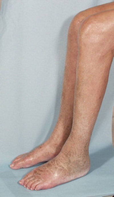 Skins lesion due to NSF