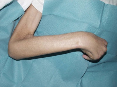 This patient suffered from universal NSF a few days before he died. The arm is fixed, and he looks starved due to the gastrointestinal fibrosis.