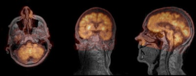 Fusion Of Ultrashort Echo Time (ute) Mr Image (gray) And Smoothed Pet Image (orange) Pet Data Attenuation Corrected Using Ute Triple Echo Mr Data From Left To Right, Transaxial, Coronal, Sagittal Cross Sections