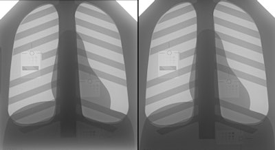 These two chest phantom images at 75kV, 4.4 mAs (left) and 90 kV, 4.4 mAs (right) were evaluated in the Scottish study. Images courtesy of Gurpreet Singh, PhD.