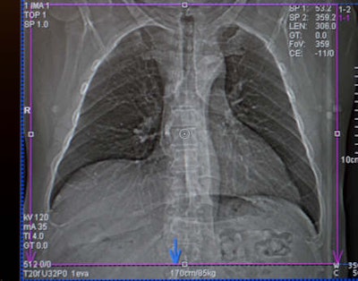 Chest CT with activated automatic dose modulation. Automatic dose modulation reduces the radiation dose by adjusting the dose along the patient's length axis. Dose modulation allows a dose reduction of up to 30%.
