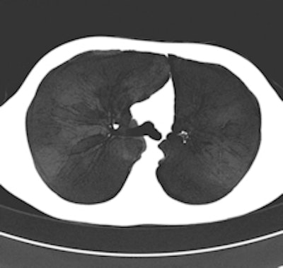 Maximum intensity projection (MIP, left) and minimum intensity projection (MinIP, right) images were calculated on demand by 24 (49%) and 20 (41%), respectively, of the survey's respondents. MIPs are particularly helpful in detecting small pulmonary nodules and determining the distribution of the nodules. MinIPs are used to ease the detection and quantification of subtle emphysema. All images provided by Dr. Helmut Prosch.